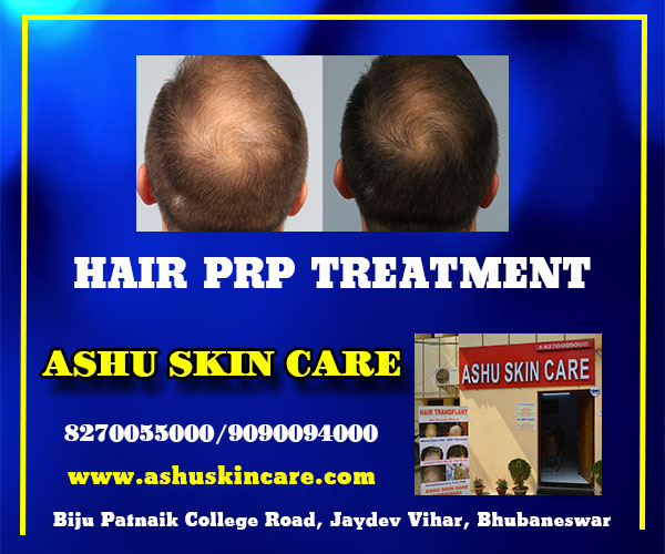best hair prp treatment clinic in bhubaneswar near me - ashu skin care